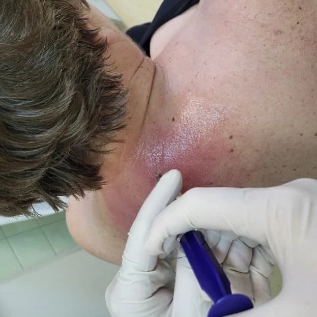 Ruka v jednorazovej rukavici drží injekčnú striekačku pri aplikácii do oblasti krčnej chrbtice; pacientka leží s hlavou odvrátenou od objektívu.