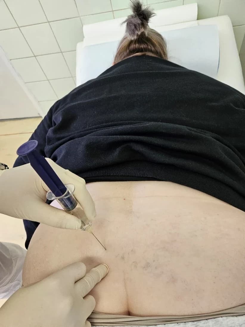 Pacientka leží na bruchu, v driekovej oblasti chrbta je paravertebrálne zavedená ihla so striekačkou.