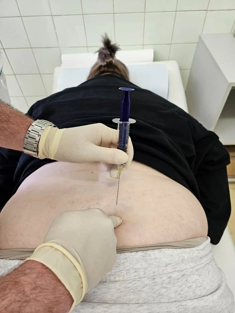 Injekčná striekačka držaná kolmo na kožu, ihla zavedená paravertebrálne v driekovej oblasti.