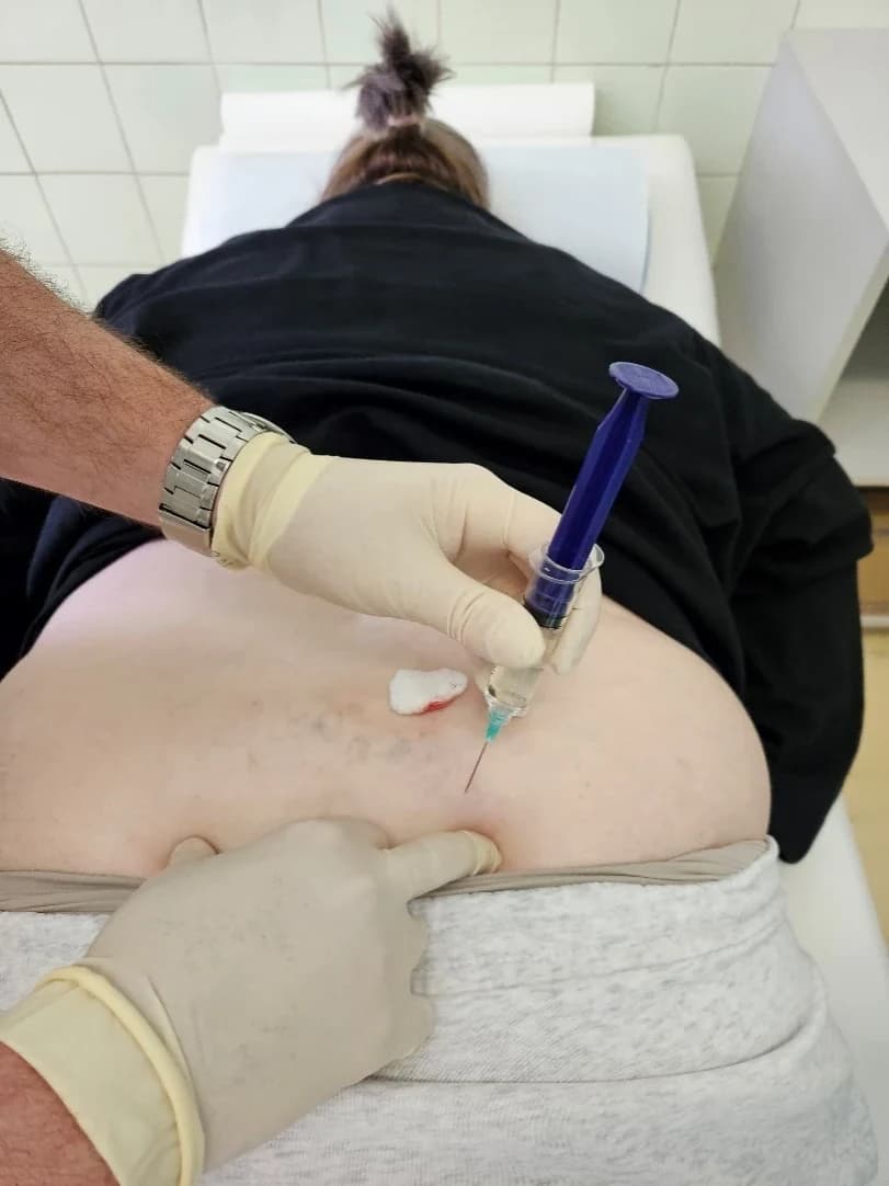 Ihla so striekačkou v mieste vpichu, vedľa nej tampón položený na koži.