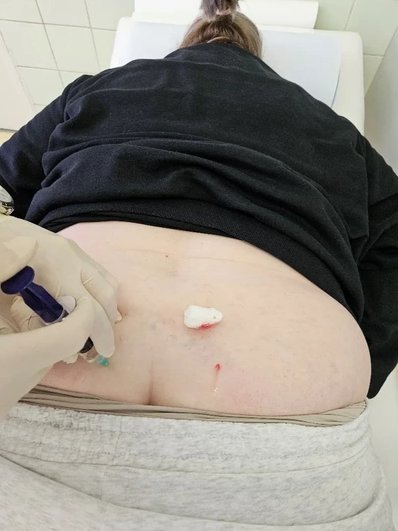 Driekový úsek chrbta po aplikácii, na koži tampón a kvapka krvi v mieste vpichu.