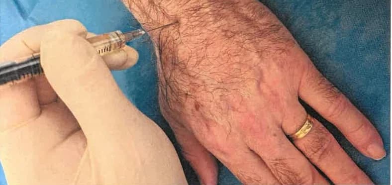 Injekčná aplikácia do ľavého zápästia v sterilných rukaviciach, ruka pacienta leží na sterilnom rúšku.