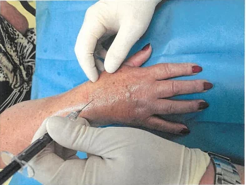 Injekčná aplikácia do pravého zápästia pacientky pri druhej aplikácii.