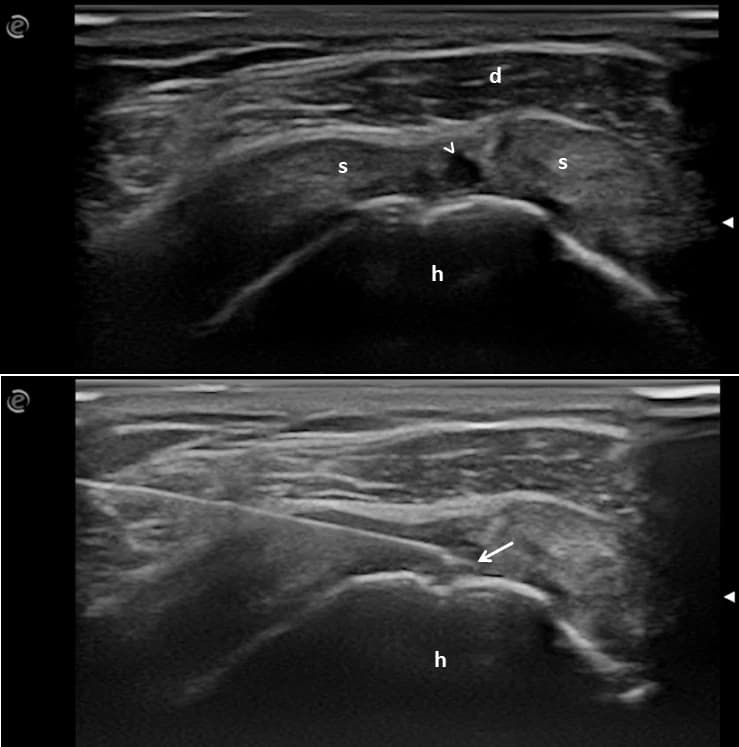 Dva pozdĺžne ultrazvukové obrazy šľachy m. supraspinatus: horný ukazuje parciálnu ruptúru šľachy označenú hrotom šípky, dolný ihlu zavedenú do lézie šľachy s hrotom označeným šípkou.